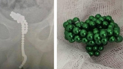50 магнитных шариков нашли врачи в уретре подростка