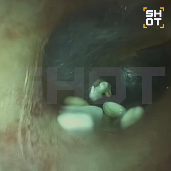 Девушка из Казани случайно привезла с Бали камни в ухе и едва избежала тюрьмы